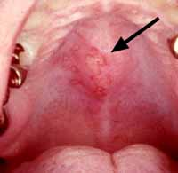 Free Uploaded Porn Movies Herpes Roof Of Mouth