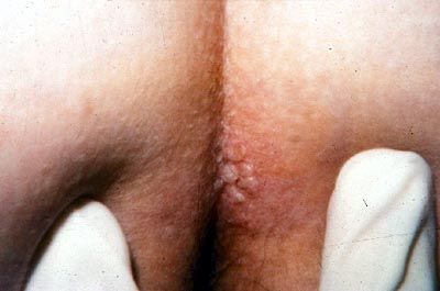 genital herpes anal Catch mom slut load