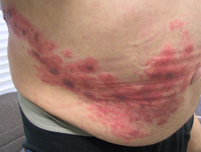 herpes zoster photos