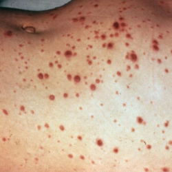 Herpes Zoster Photos