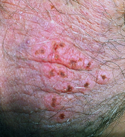 male-herpes-photo-outbreak-balls.png