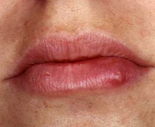 Mild Herpes Photos Mild Herpes Symptoms Picture