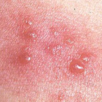 What Does Herpes Look Like?