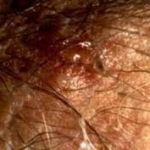 Ulceration stage of herpes outbreak